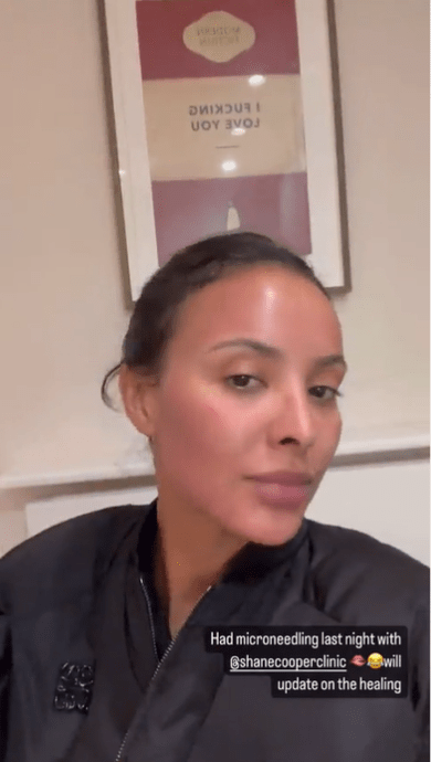 Maya Jama revealed her red raw face after undergoing a skin tightening procedure