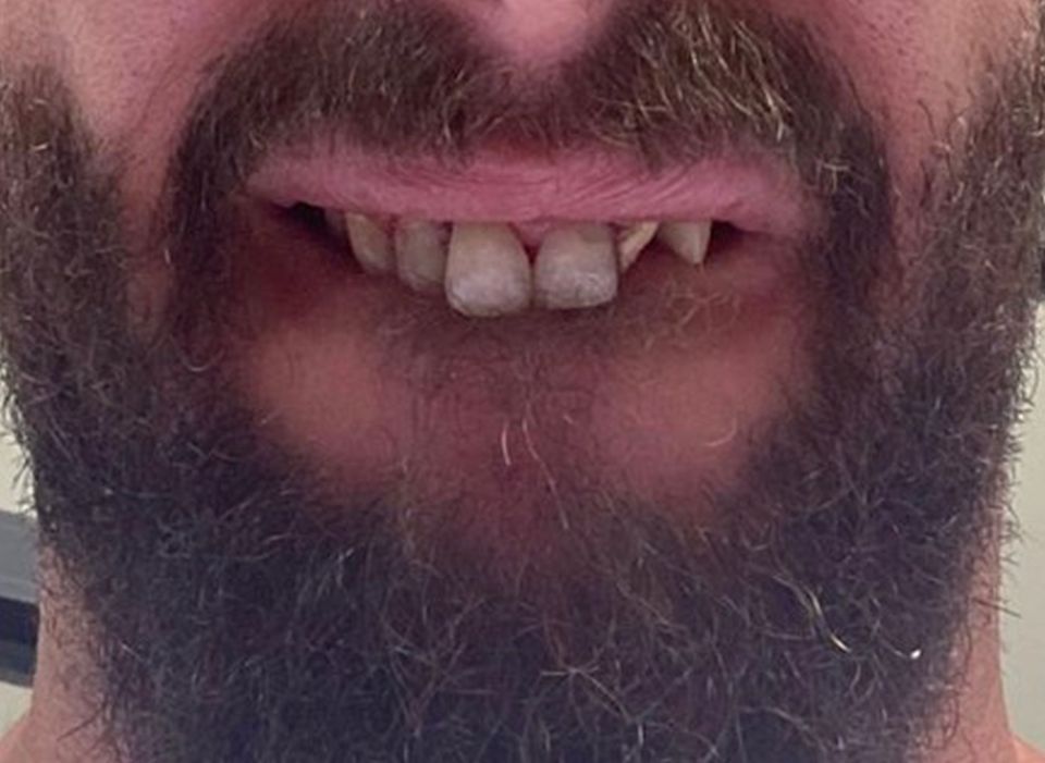 Terry's teeth before he got veneers