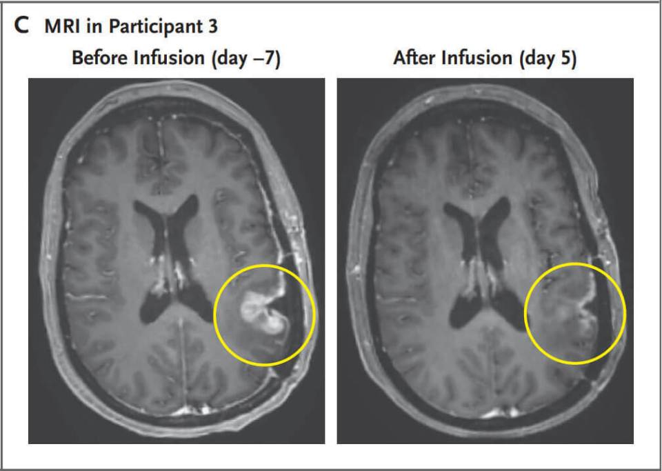 A woman's brain tumour nearly completely regressed five days after having CAR-T therapy