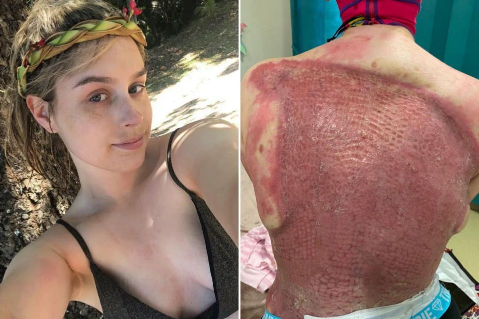 Stephanie Browitt, then 23, from Melbourne, suffered burns to 70 per cent of her body