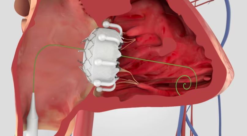 A new valve is placed in the heart under light anaesthetic