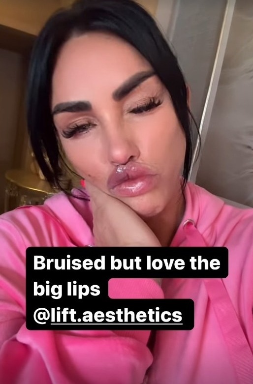 Katie Price flaunted her bruised lips