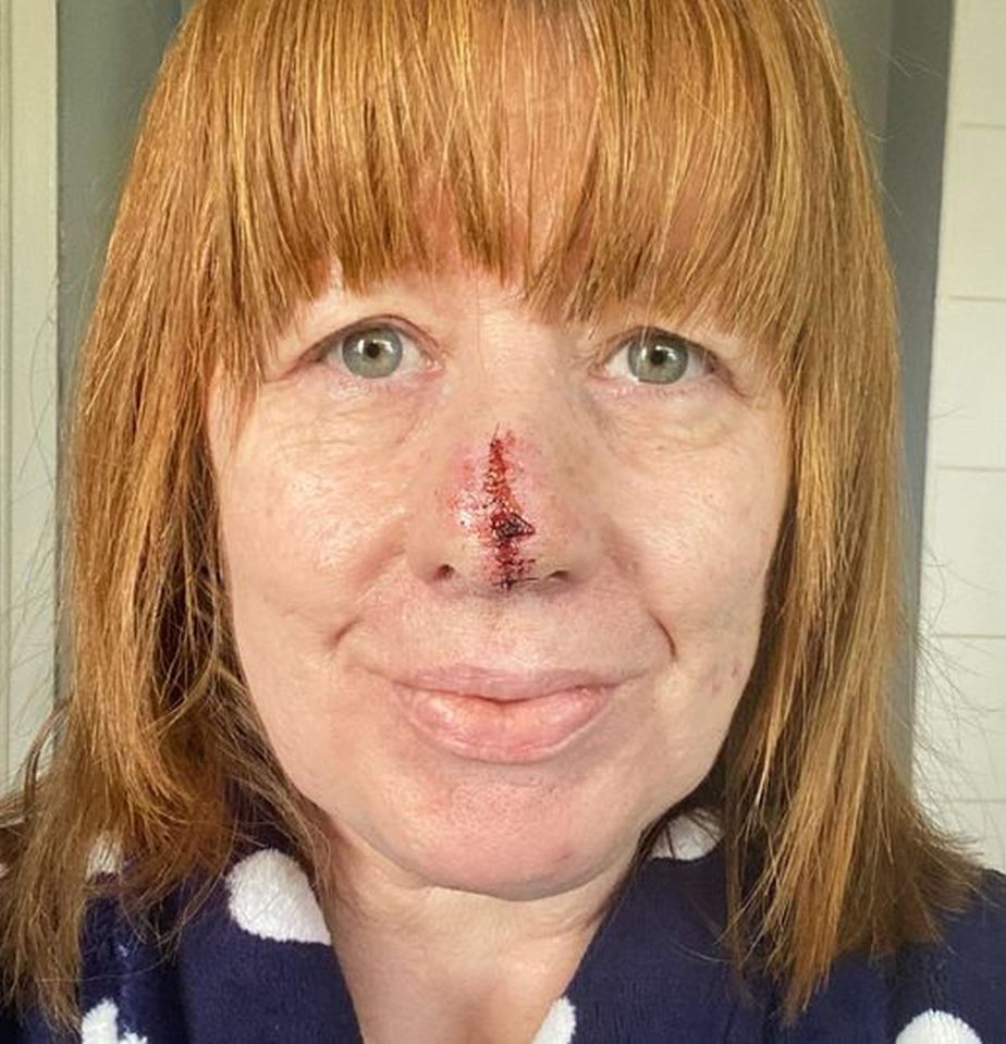 Sarah Jones had a chunk of her nose cut off after her dentist spotted cancer