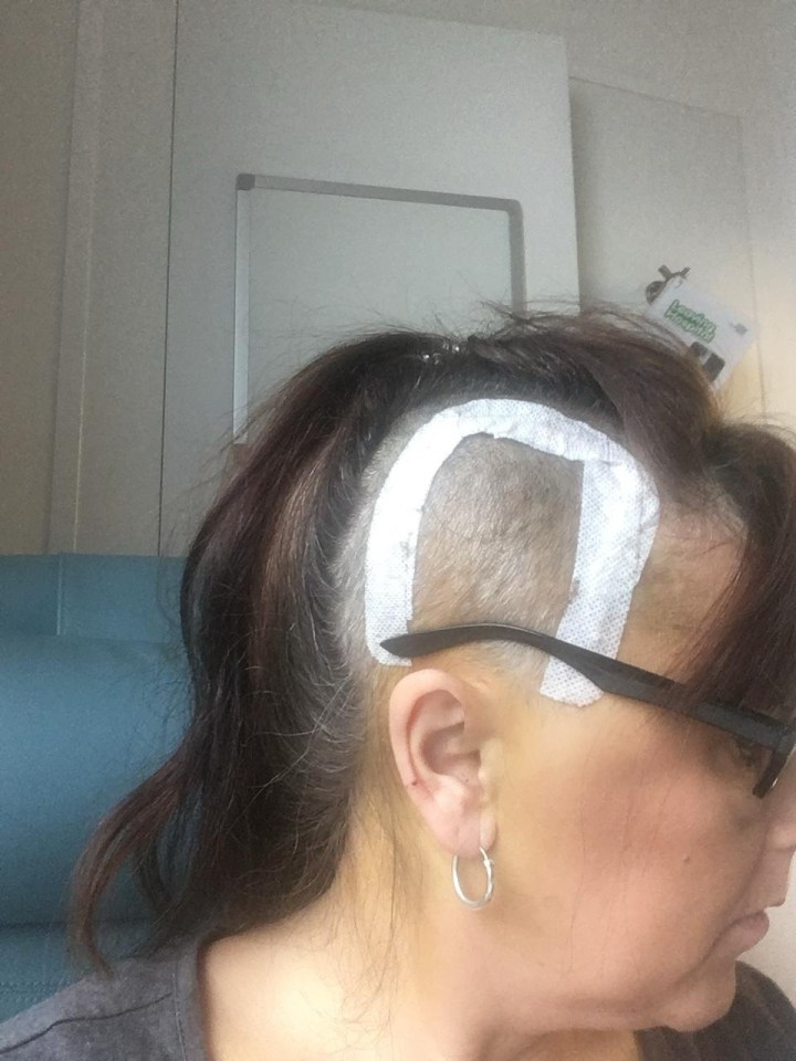 Denise showing the bandage over her scar post surgery - she also underwent radiotherapy and chemotherapy