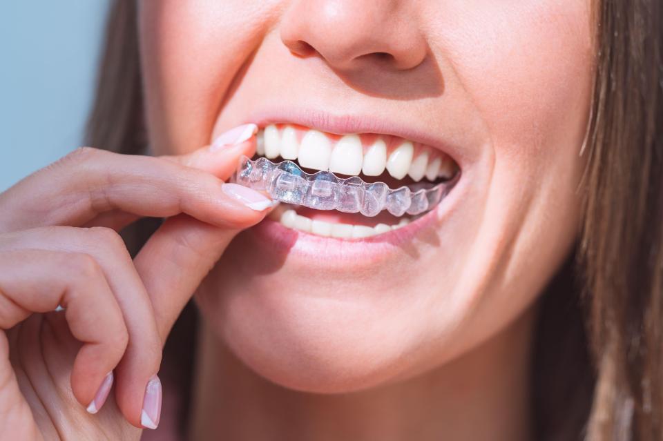 The worst at-home teeth whitening gels contain 300 times the permitted amount of hydrogen peroxide bleach