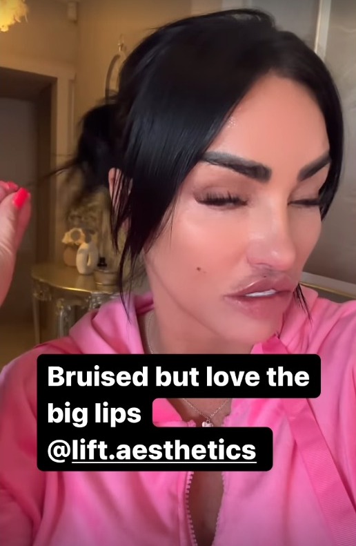 Katie admitted that she wants 'extra, extra, extra' big lips