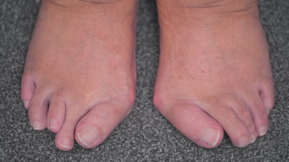 Sue had a three-hour op to remove the disfigurement on her left foot