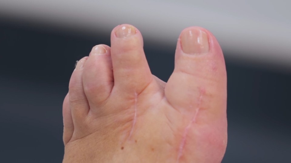 Sue's feet after the operation