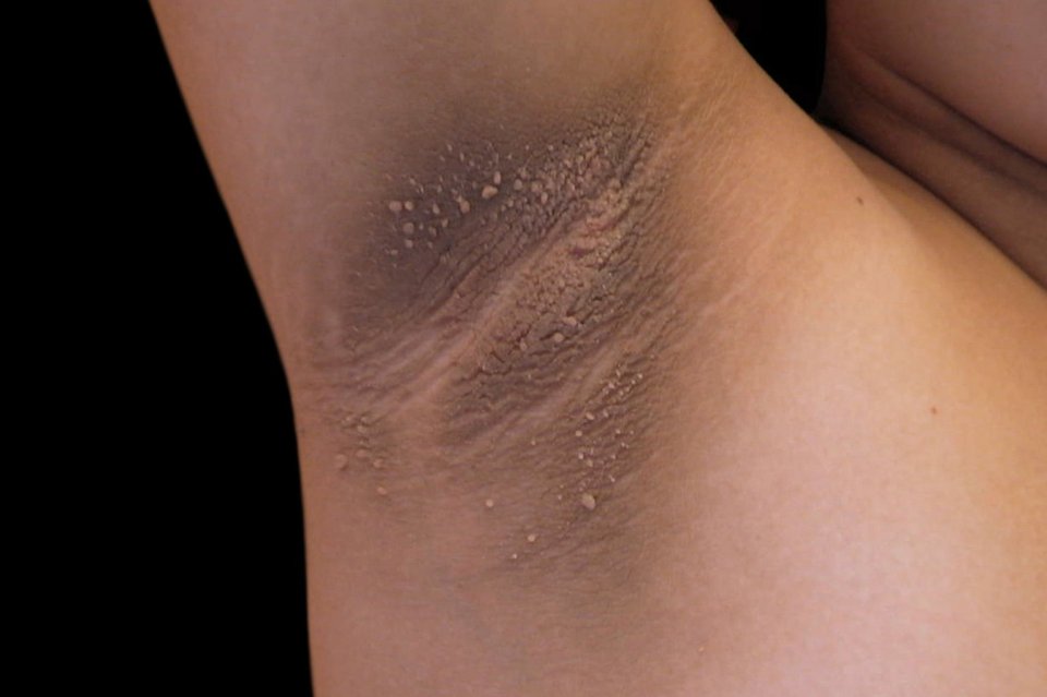 They're most common in skin folds, such as the armpits, neck or groin