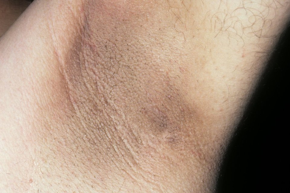 Acanthosis nigricans is the name for dry, dark patches of skin that usually appear in the armpits, neck or groin