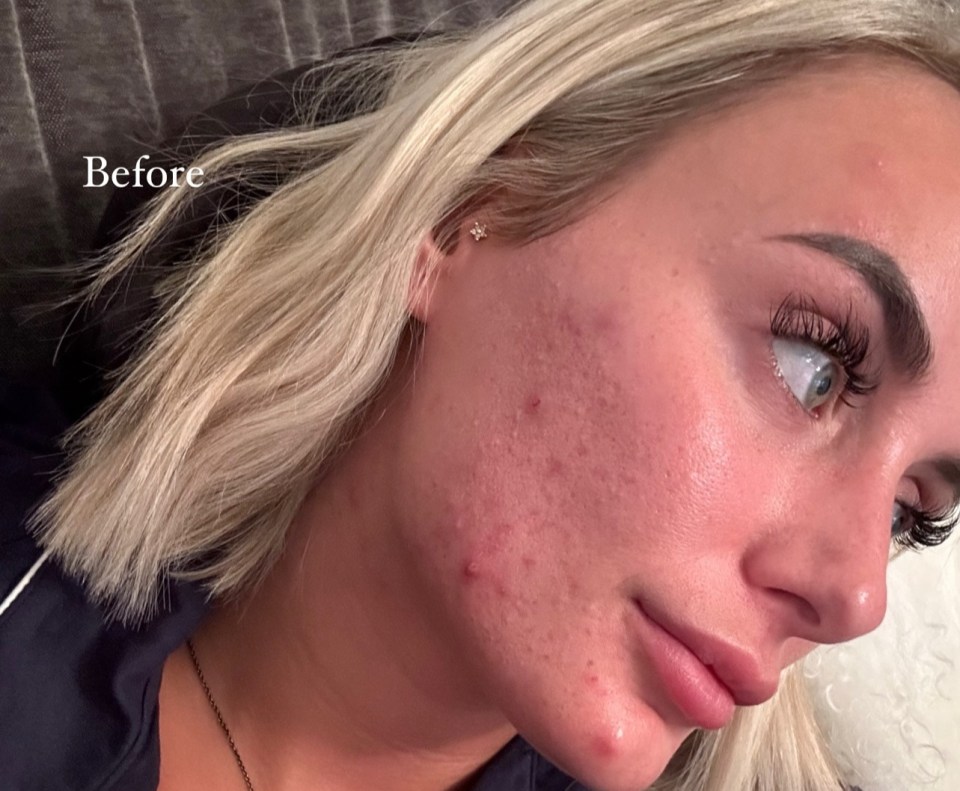 Millie Court shared her results after using Roaccutane