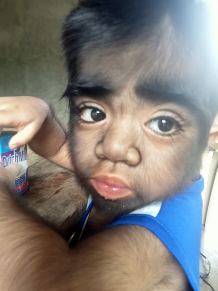 Jaren, from the Philippines, was born with a condition called hypertrichosis