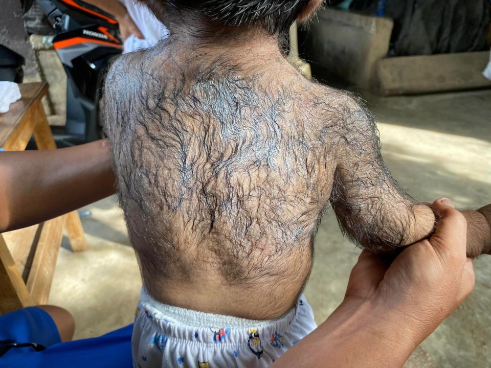 The boy has a 'werewolf-like' appearance as hair also covers his whole back