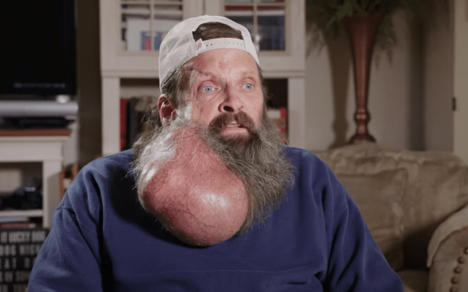 Tim, 62, had a watermelon sized tumour growing out of his face, which swelled in size over 16 sixteen years