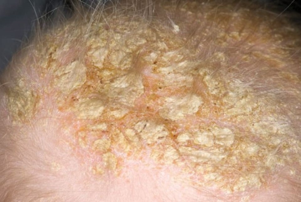 Seborrheic dermatitis causes a scaly rash on oily areas of the face and scalp