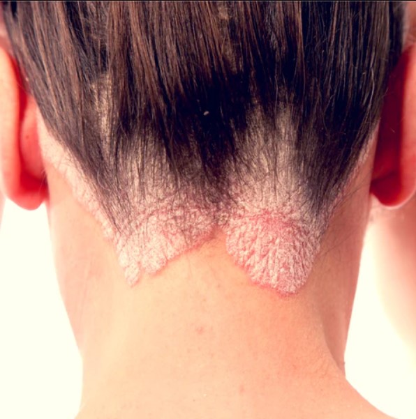 Scalp psoriasis causes patches of skin covered in thick scales