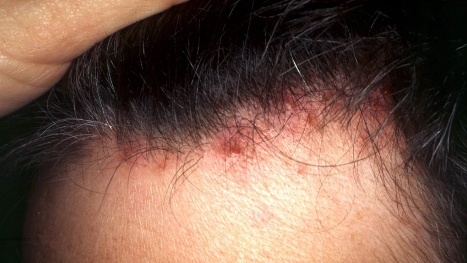 Folliculitis is a skin problem that happens when you get bacteria or a blockage in a tiny pocket in your skin