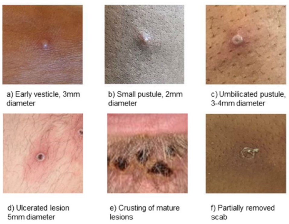 Mpox lesions at various stages.