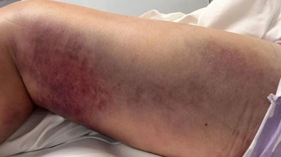 Harrowing image showing her severely bruised and swollen leg after the horror snake attack