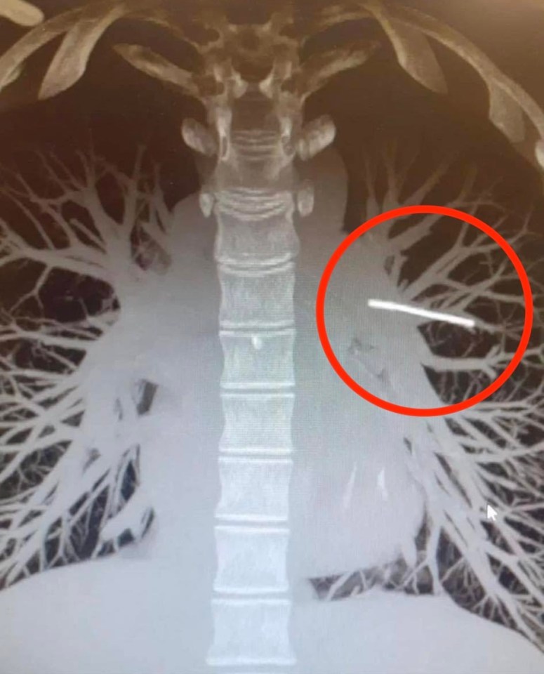 Doctors found that the implant had migrated to her lung (see white line circled red)