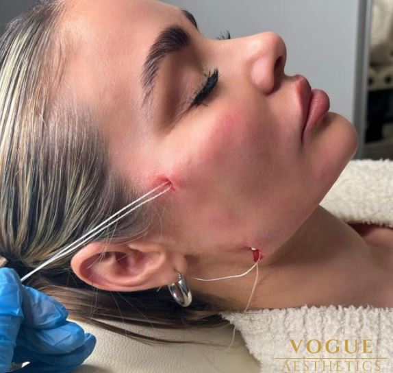 Towie’s Chloe also shocked fans with VERY gory pics of face threads in 2022