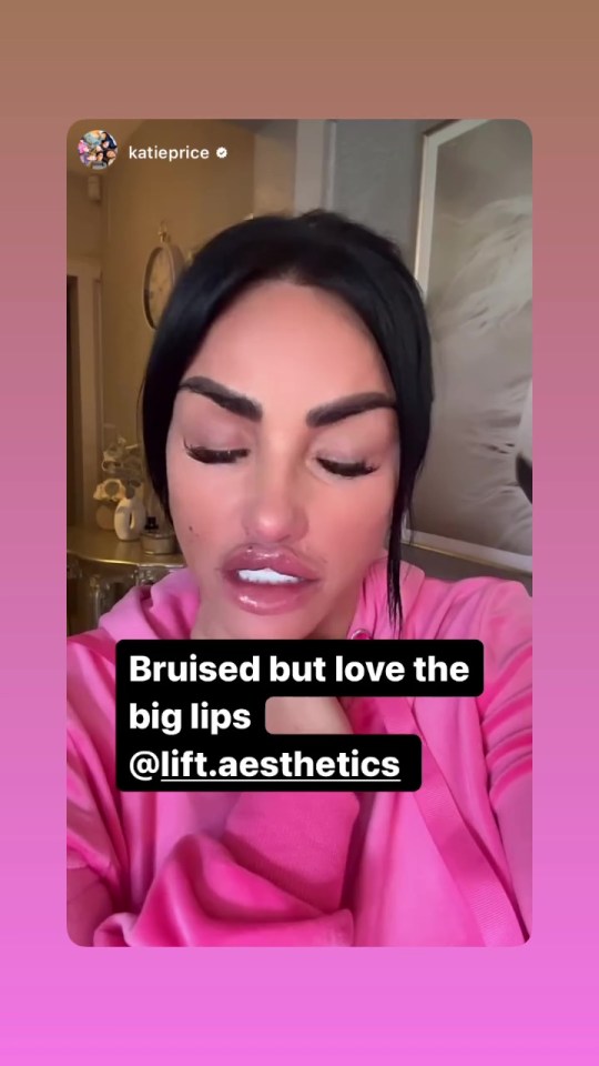 Katie seems to enjoy the effect of bee stung lips and no doubt many of her fans will follow suit