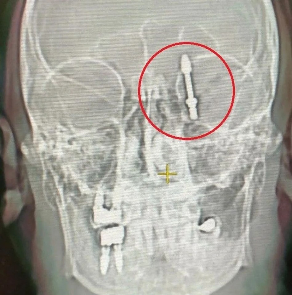 An X-ray showing the dental implant which was in Yilmaz's brain