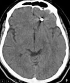 A view of his brain and the location of the implant from above