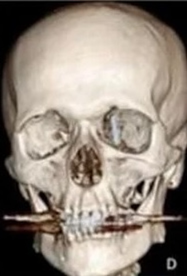 Another X-ray image shows the location of the dental implant behind Yilmaz's eye