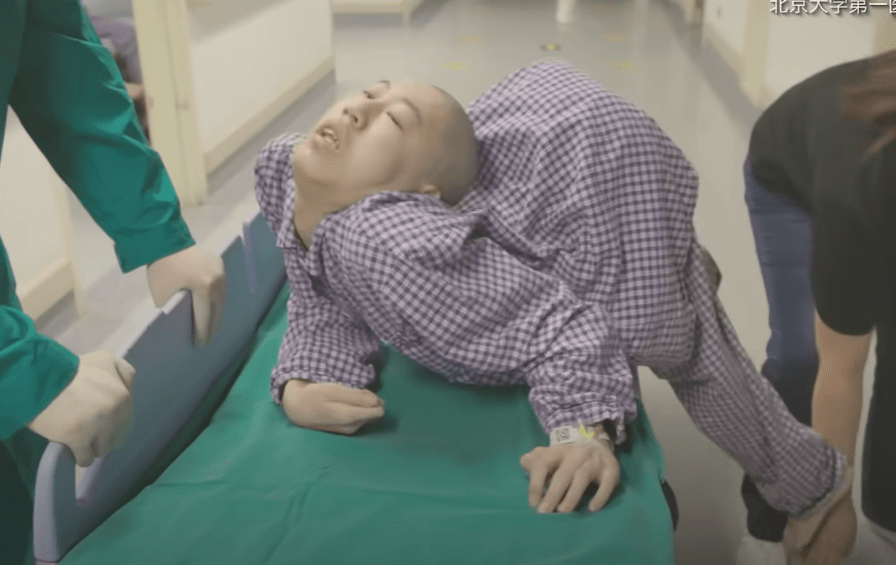 Jiang Yanchen, 19, from the Shandong province in China, underwent two risky operations to correct the 180 degree fold in his spine