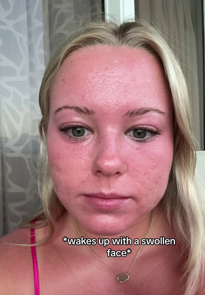 Elise learnt a harsh lesson about sun poisoning while on holiday in Puerto Rico