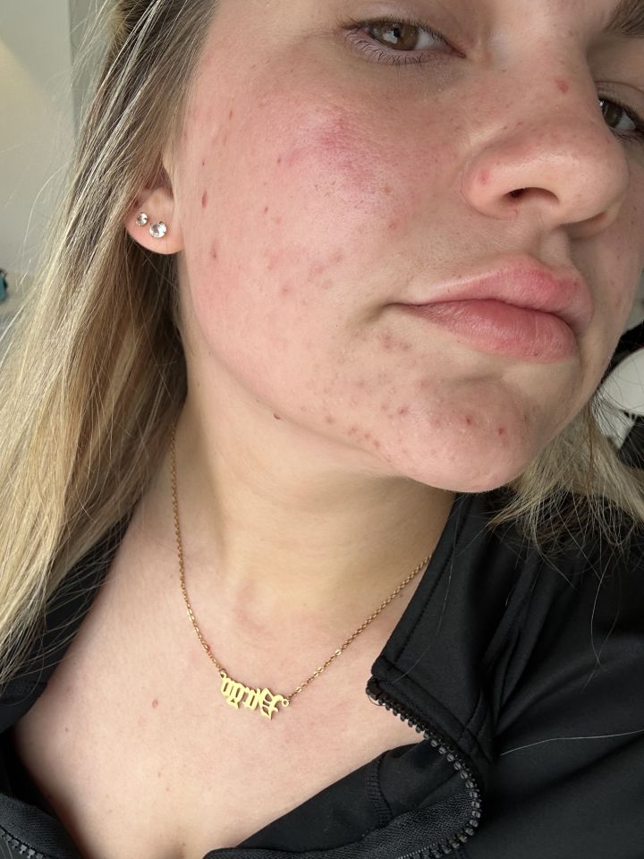 The mum-of-two developed acne - which she believed was caused by the contraception