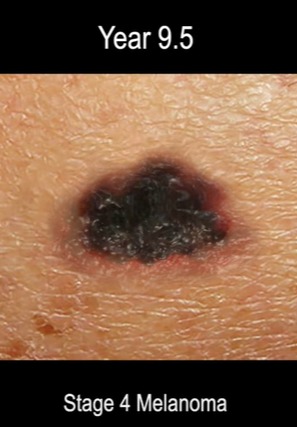 Stage 4 melanoma has spread to other organs such as the lungs, liver, bones or brain.