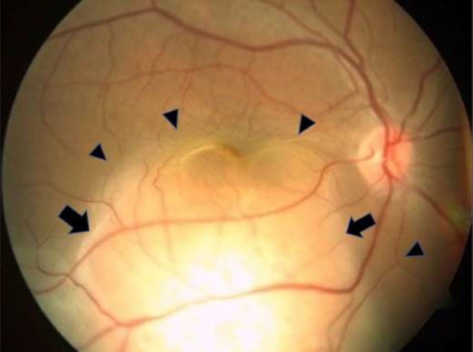 Scans found a growth on the inside black surface known medically as the fundus of her right eye