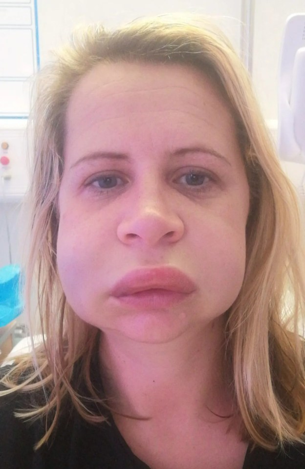 Claire Shorrock was left with a 'deformed face' after root canal treatment