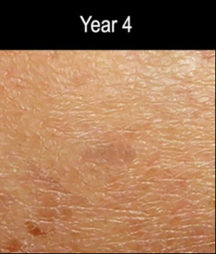 The chilling time lapse shows how a dark patch of skin could morph into deadly melanoma skin cancer over a decade