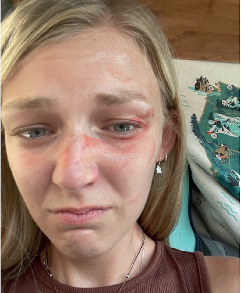 Gabby's face was bruised when the couple were stopped by police