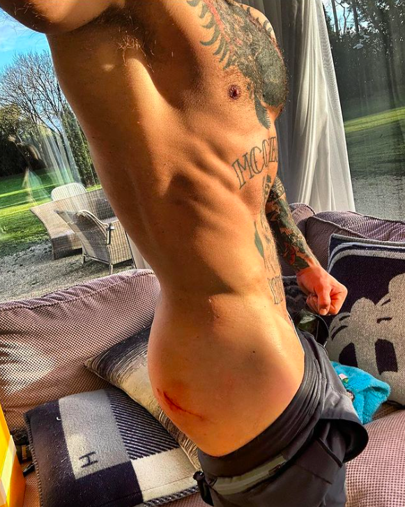 McGregor showed off his wounds from the crash