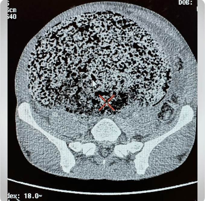 Scans shared by a radiologist the horrifying reality of what not being able to poo for months looks like