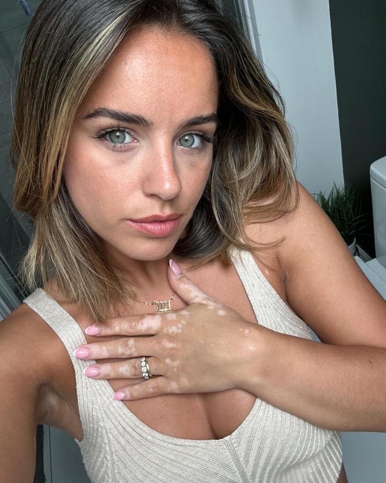 Georgia May Foote has spoken out about her vitiligo