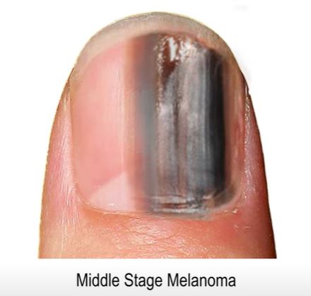 It is most likely to show up on the thumb or big toe of your dominant hand or foot