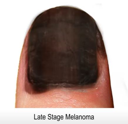 During the later stages of the disease the the nail and skin around it begins to turn black/brown