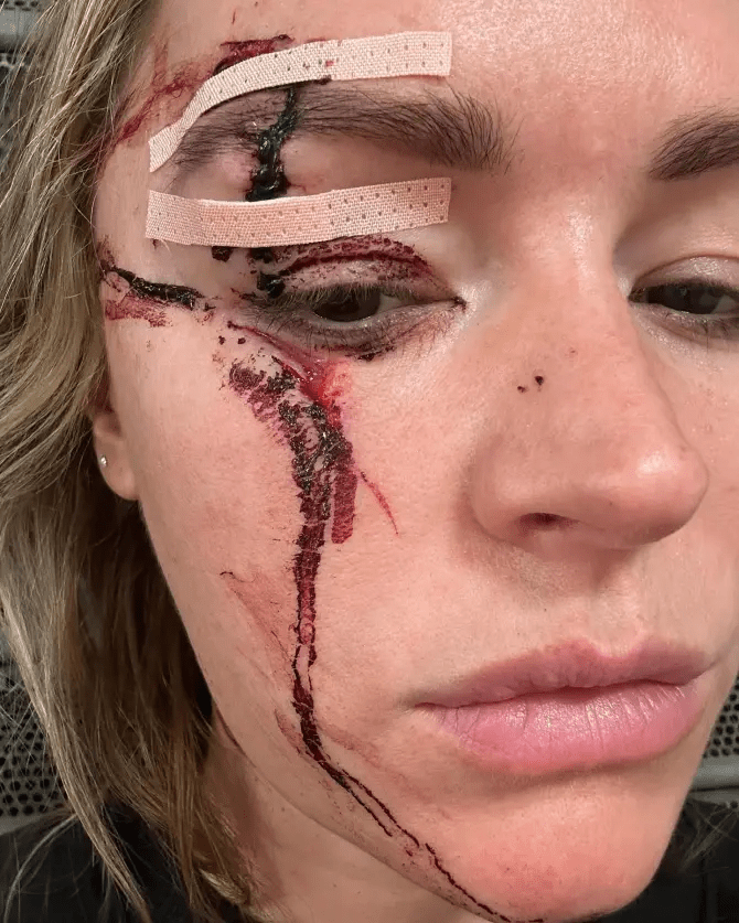 Laura Woods suffered horror facial injuries after a freak accident ruled her out