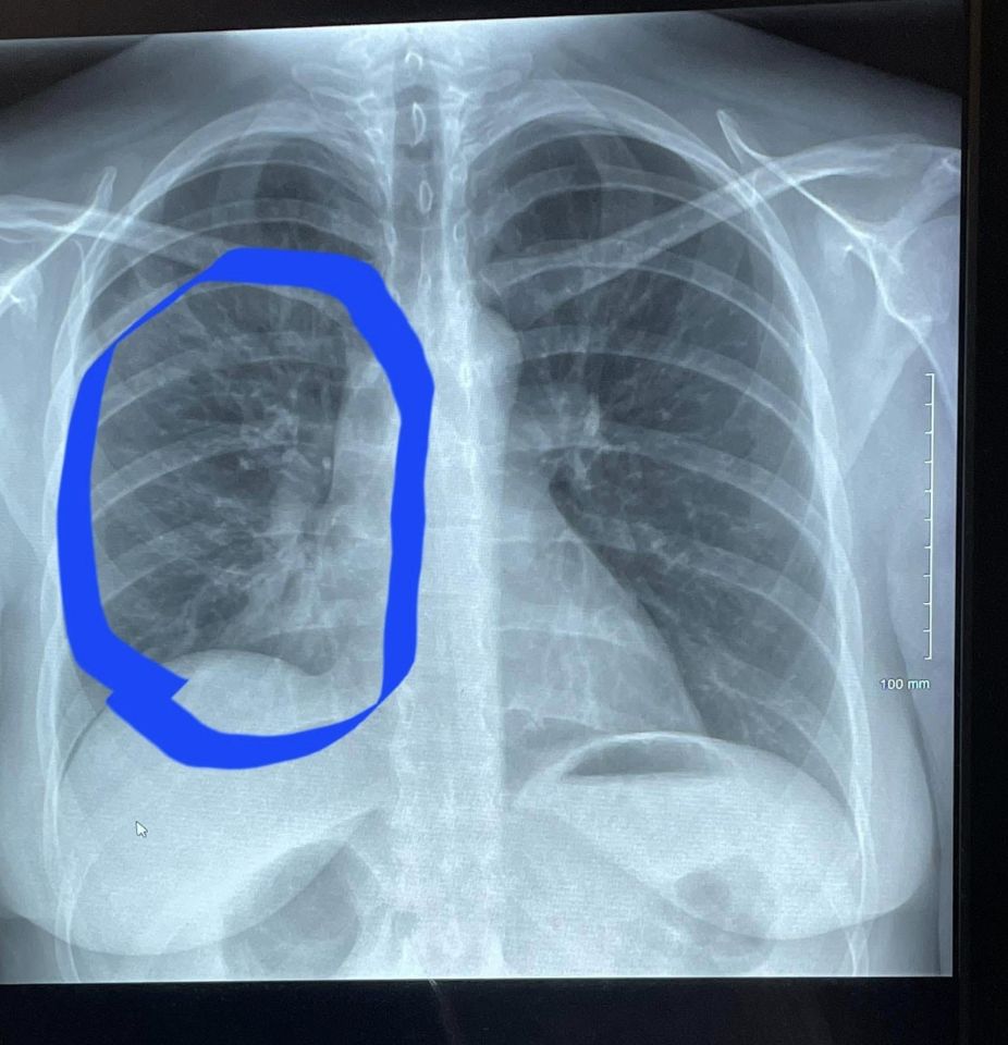 A scan of Hannah's lungs when she was suffering from pneumonia