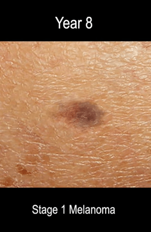 At stage 1 melanomas tend to be no more than 2mm thick and have not spread to other parts of the body