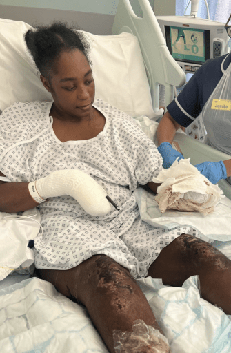 She woke up in hospital and all of her limbs had turned black from the infection