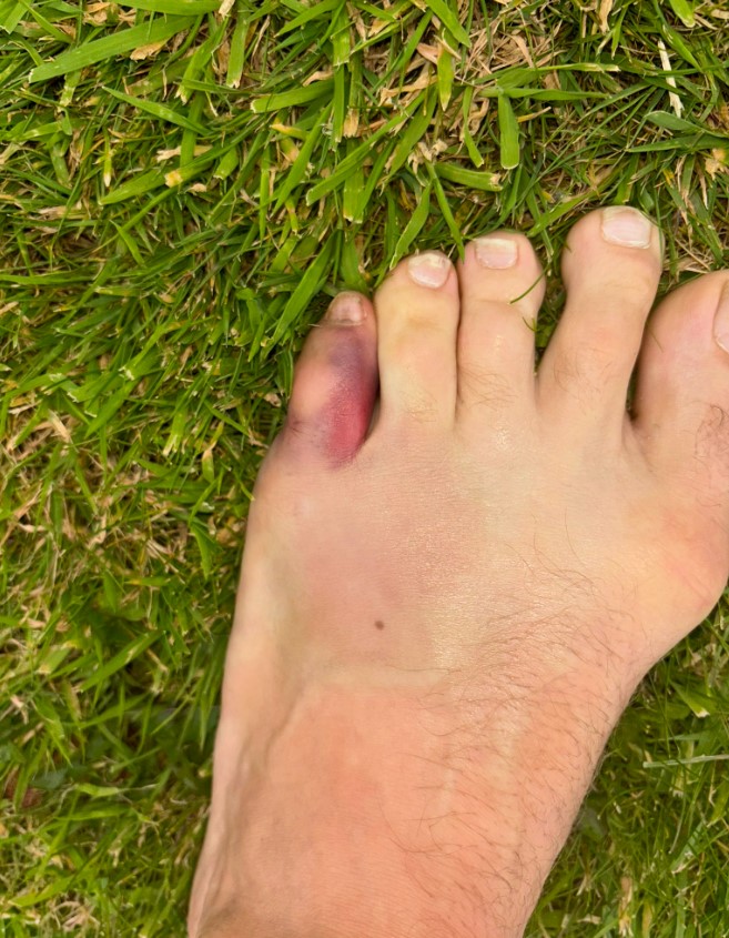 The toe injury that forced McGregor out of UFC 303