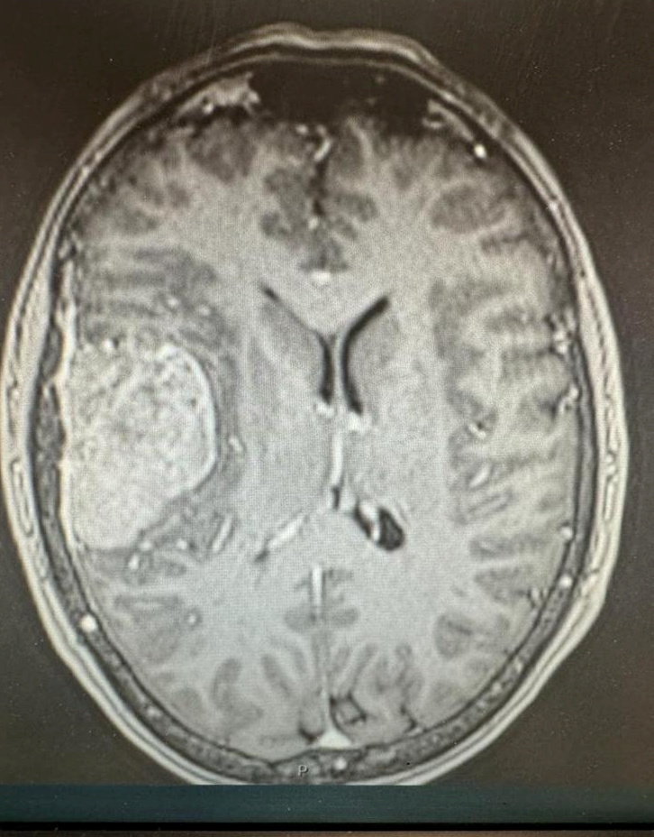 The scan which revealed the benign mass on her brain