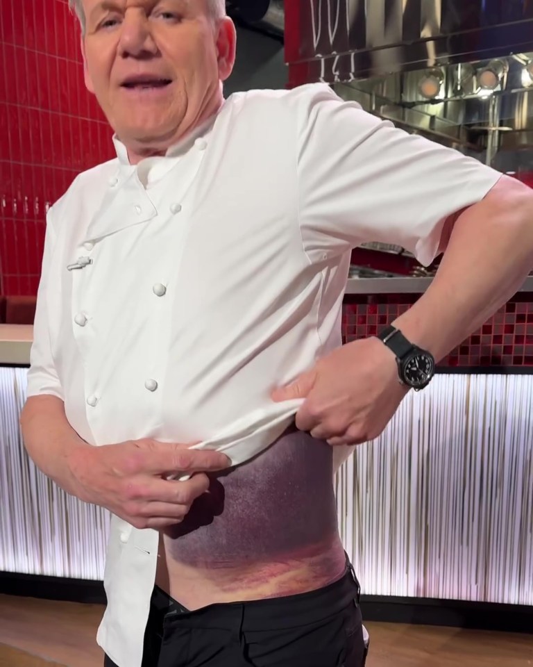 Gordon Ramsay's bruising after a bike accident