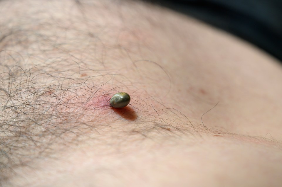 You should try and remove ticks with fine-toothed tweezers